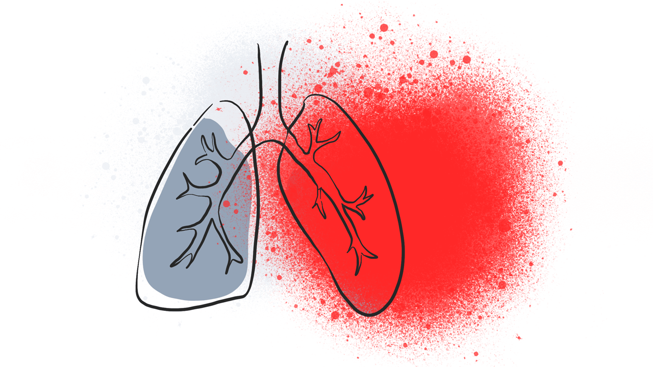 Asbestose og lungehindekræft